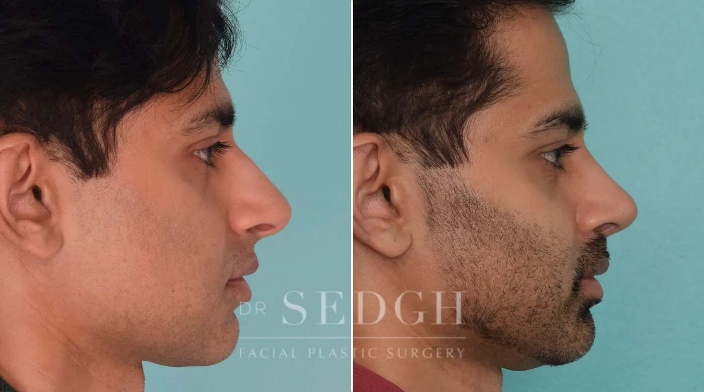 Patient 210 after Middle Eastern Rhinoplasty, view 1