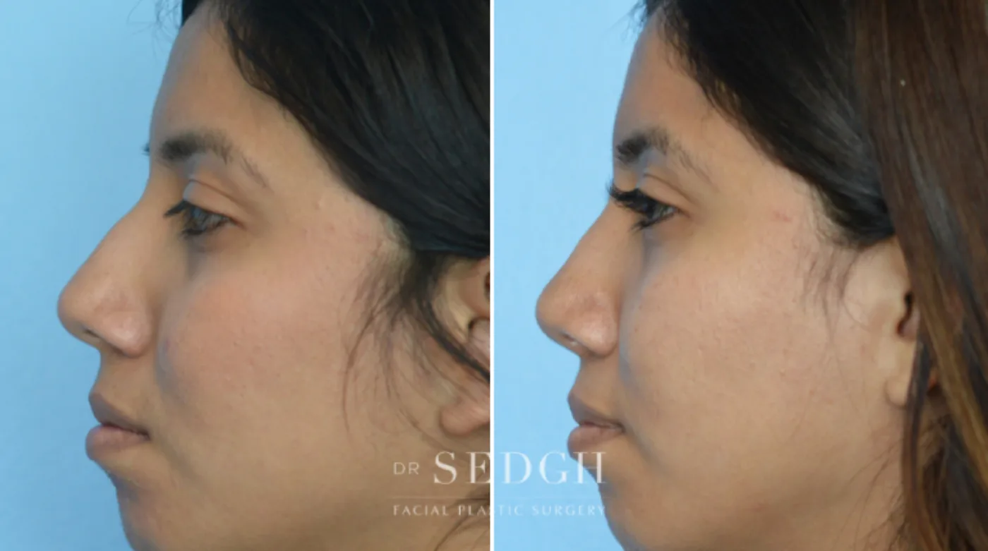 Patient 13 after Crooked Nose Surgery, view 1