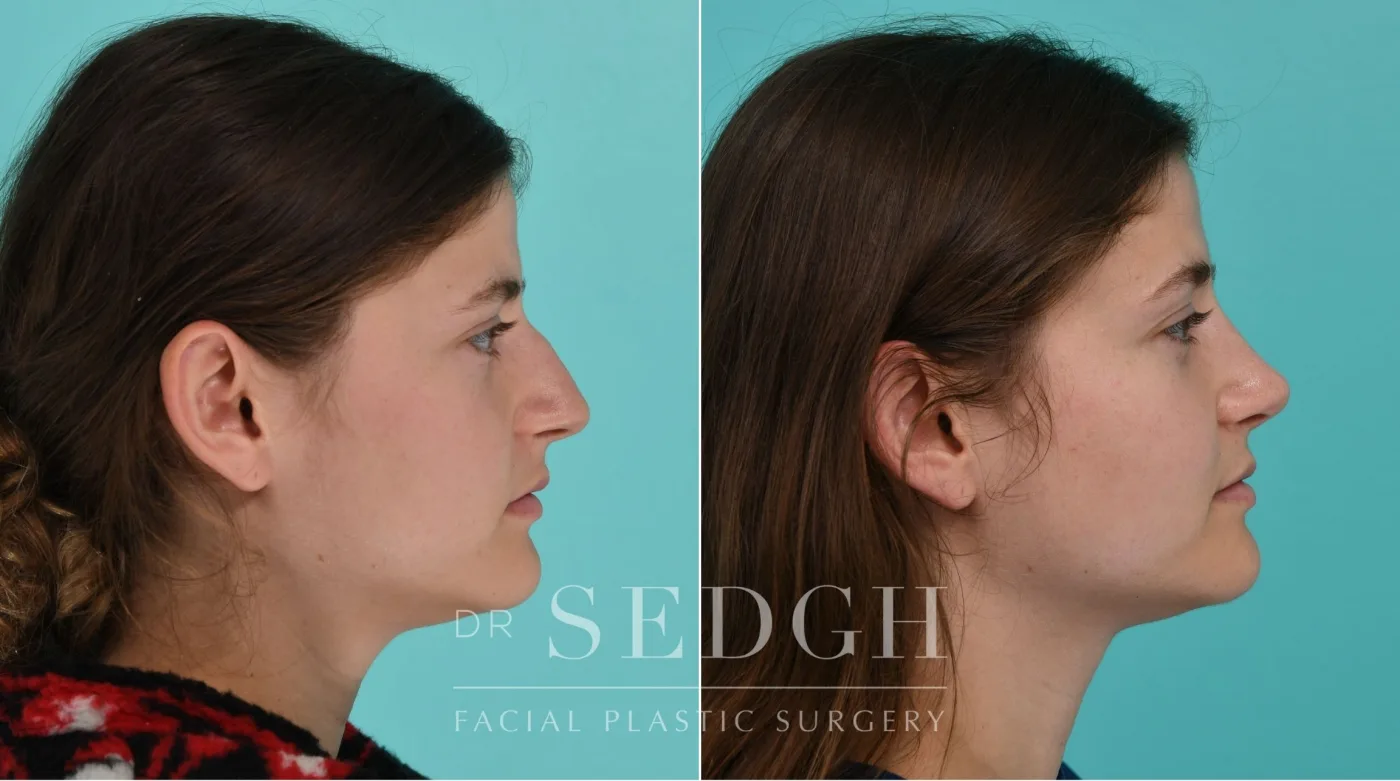 Patient 338 before Female Rhinoplasty, view 1