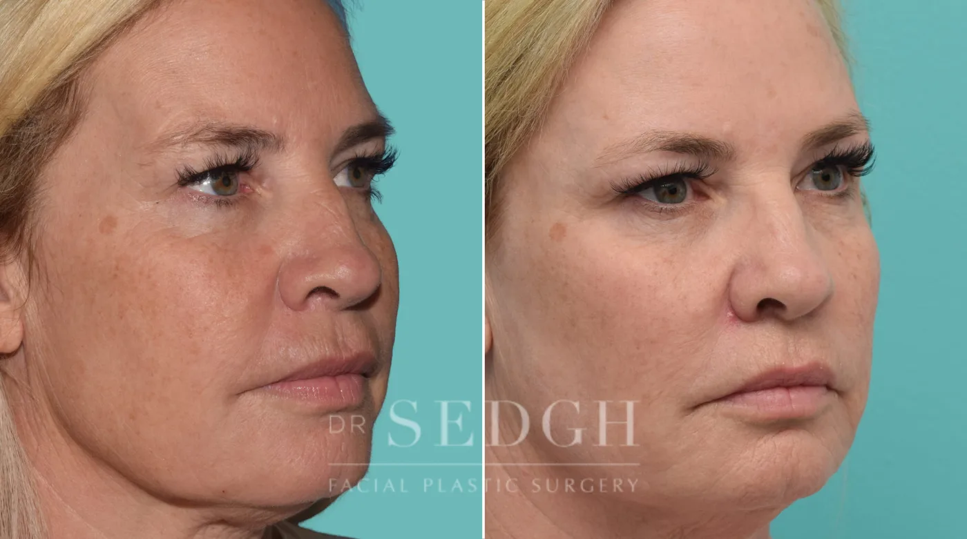 Patient 183 after Facial Fillers, view 1