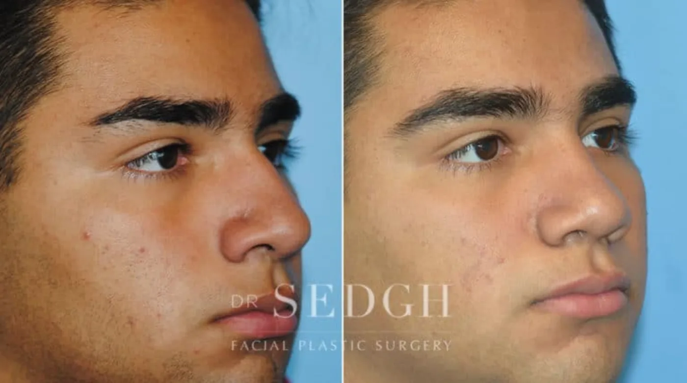 Patient 4 after Crooked Nose Surgery, view 1