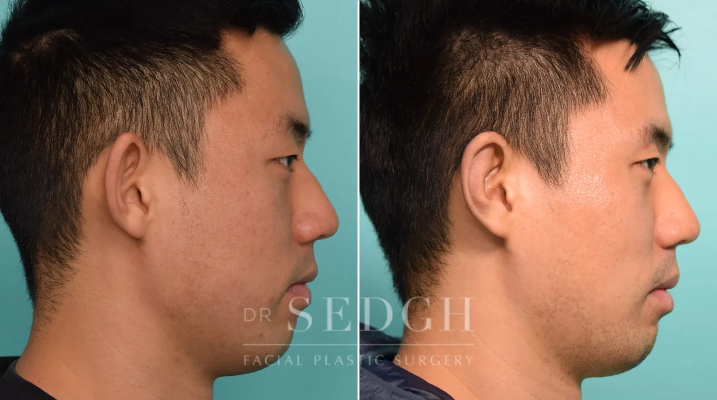 Patient 265 after Ear Pinning Surgery, view 2