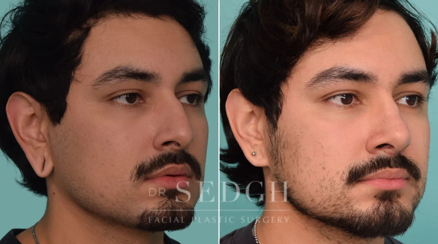 Patient 228 before Ear Lobe Repair, view 2