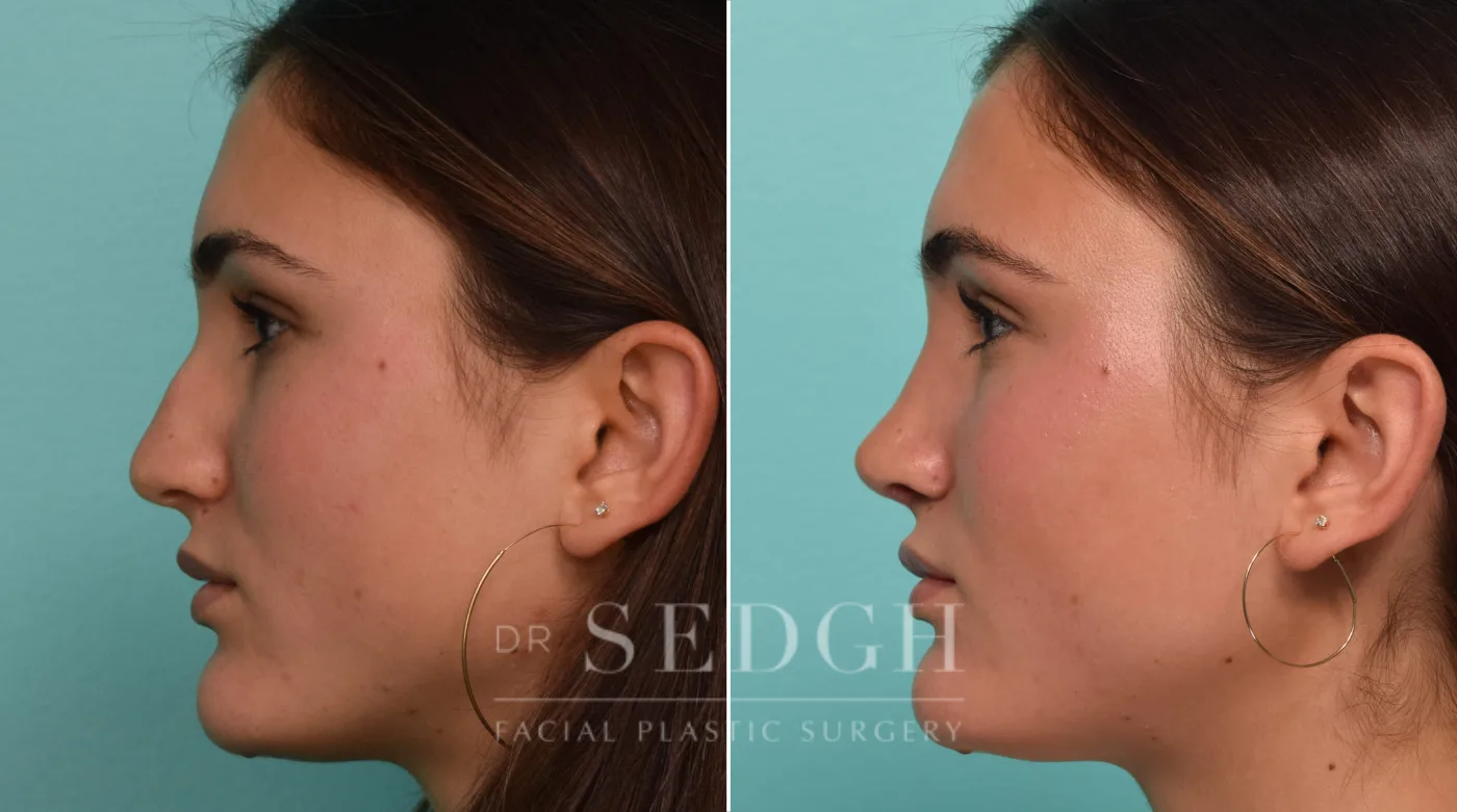 Patient 308 after Rhinoplasty, view 1