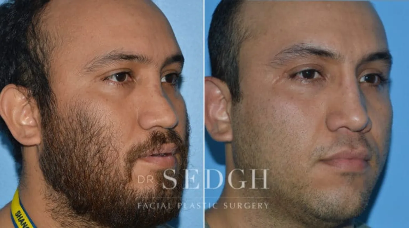 Patient 15 after Crooked Nose Surgery, view 1