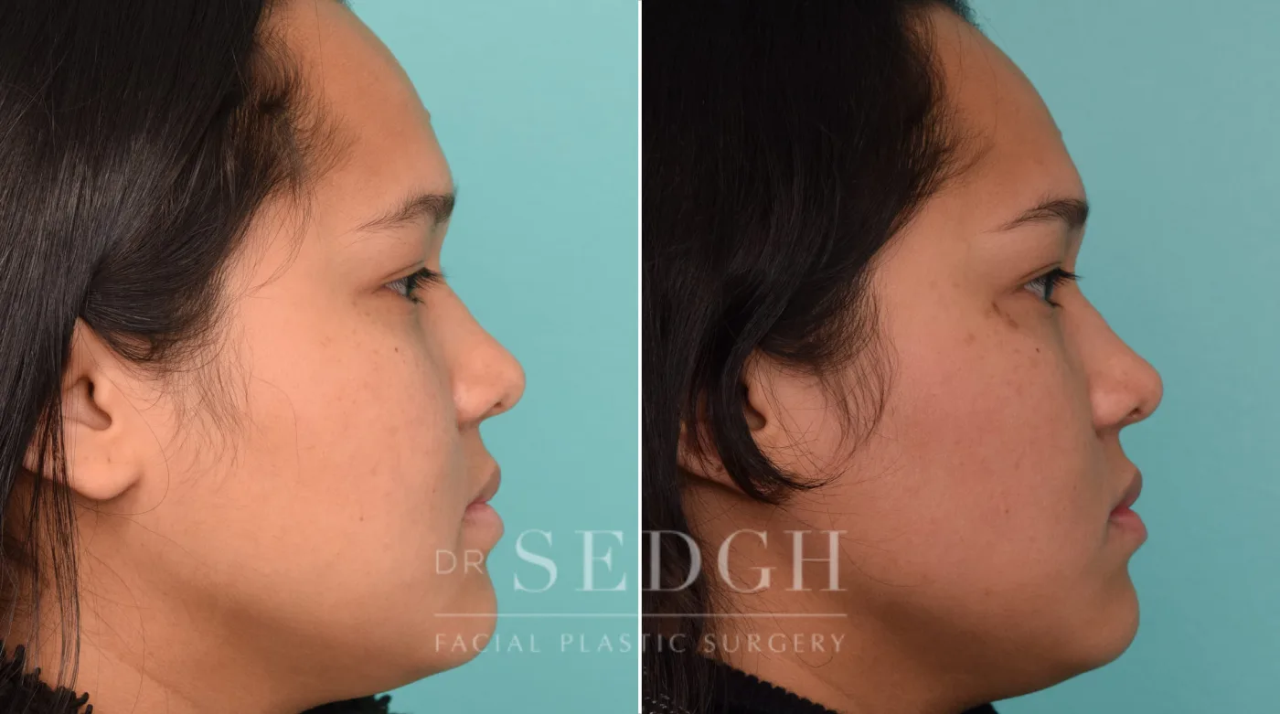 Patient 238 after Buccal Fat Reduction, view 1