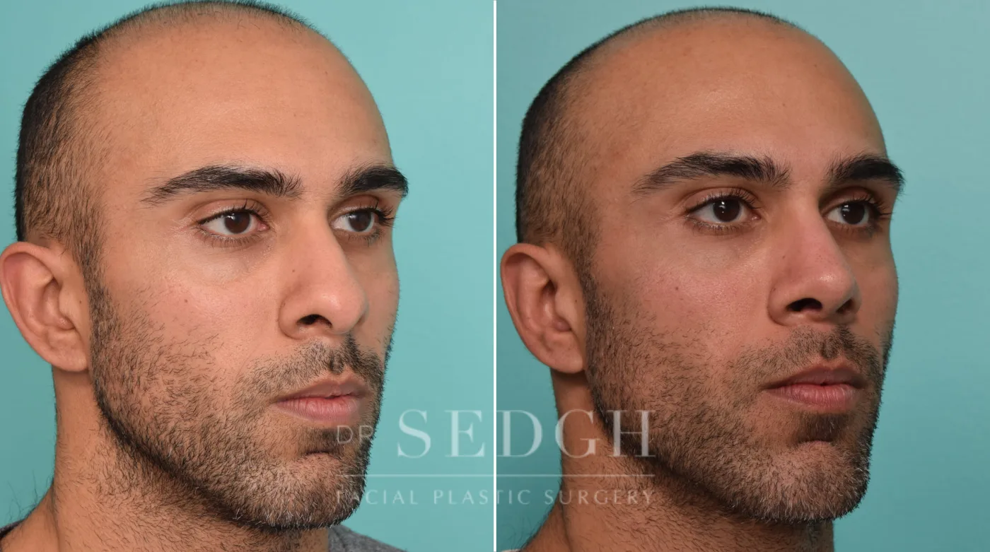 Patient 263 before Male Rhinoplasty, view 1