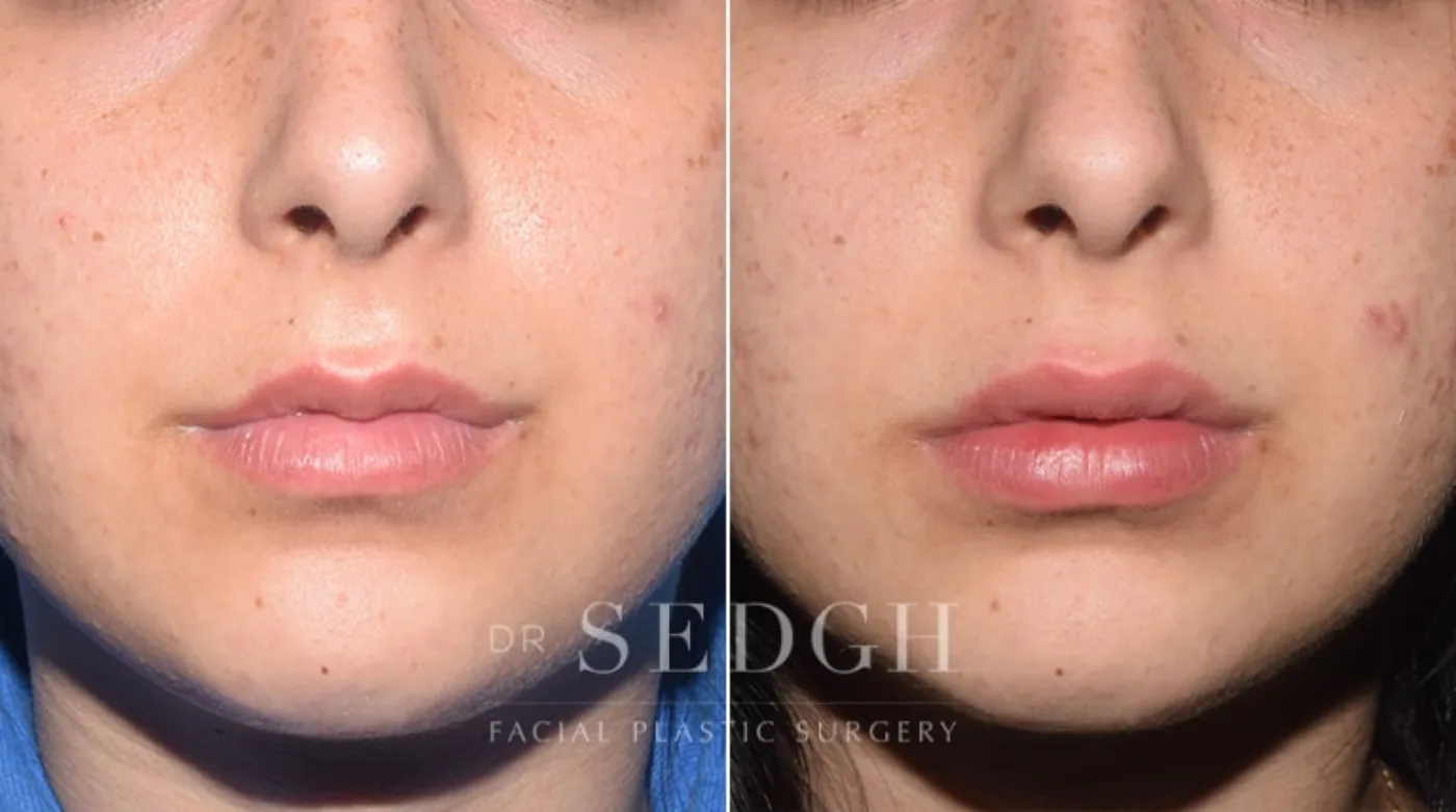 Patient 8 before lip augmentation, view 1