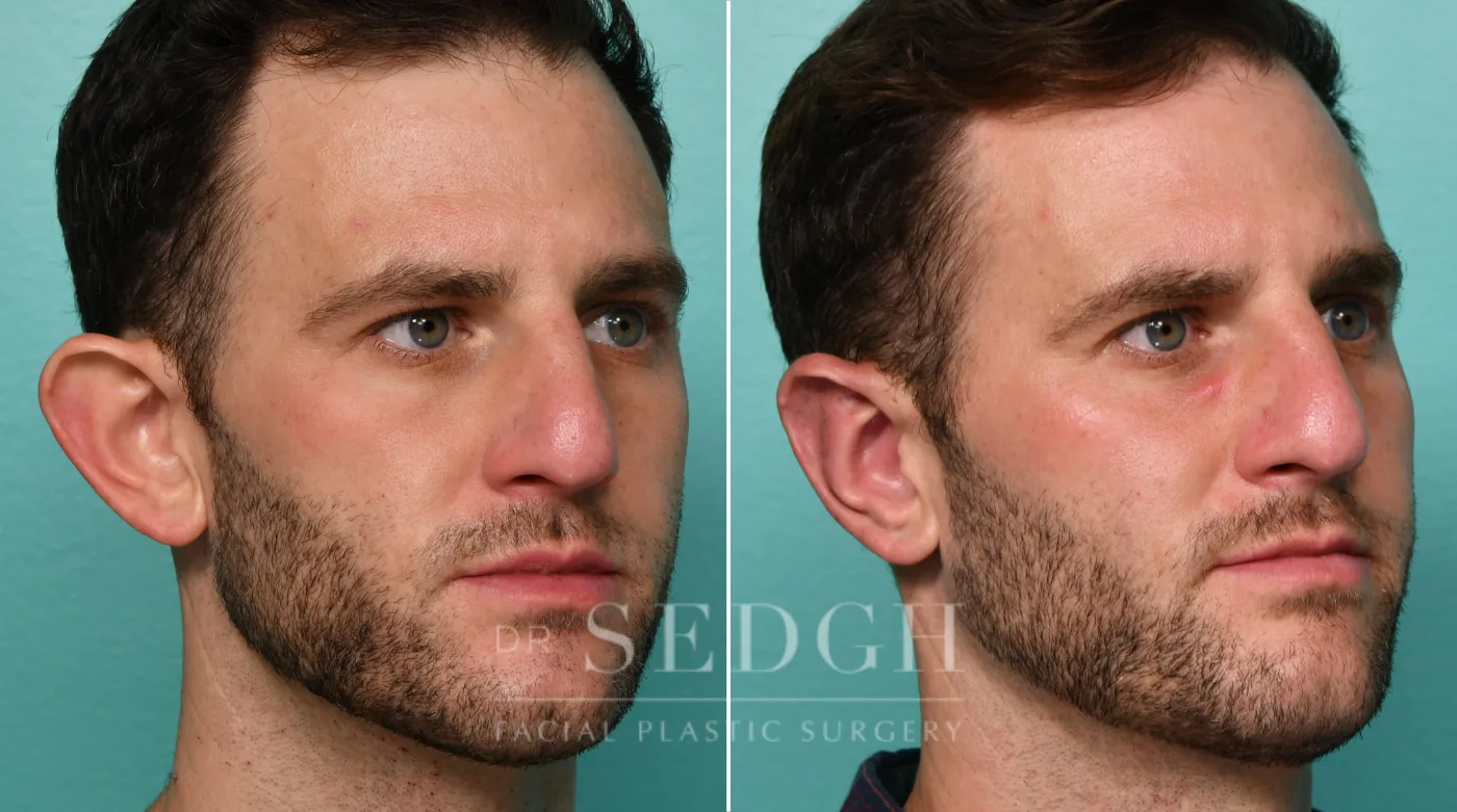Patient 320 before Ear Pinning Surgery, view 1