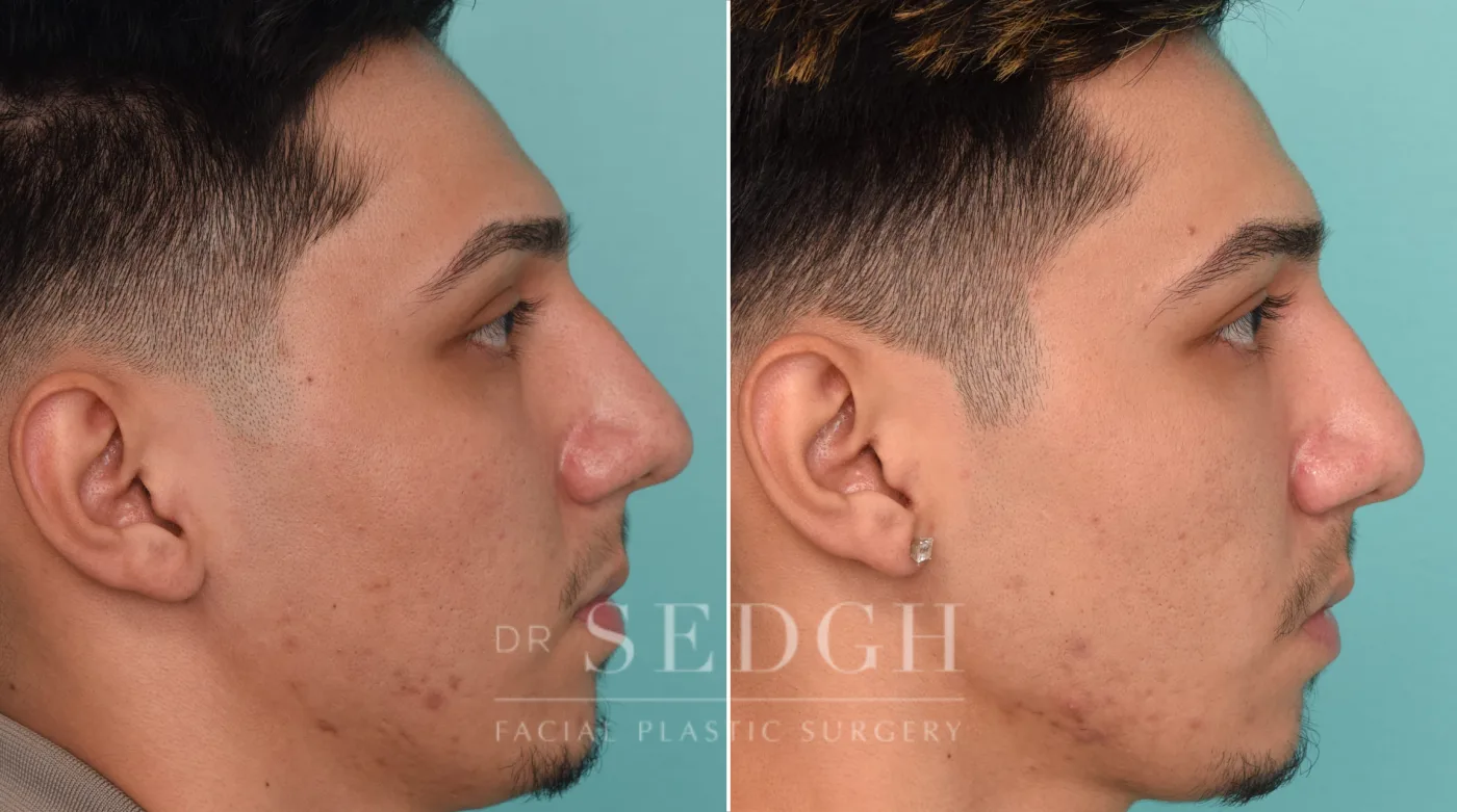 Patient 257 after Ear Pinning Surgery, view 2