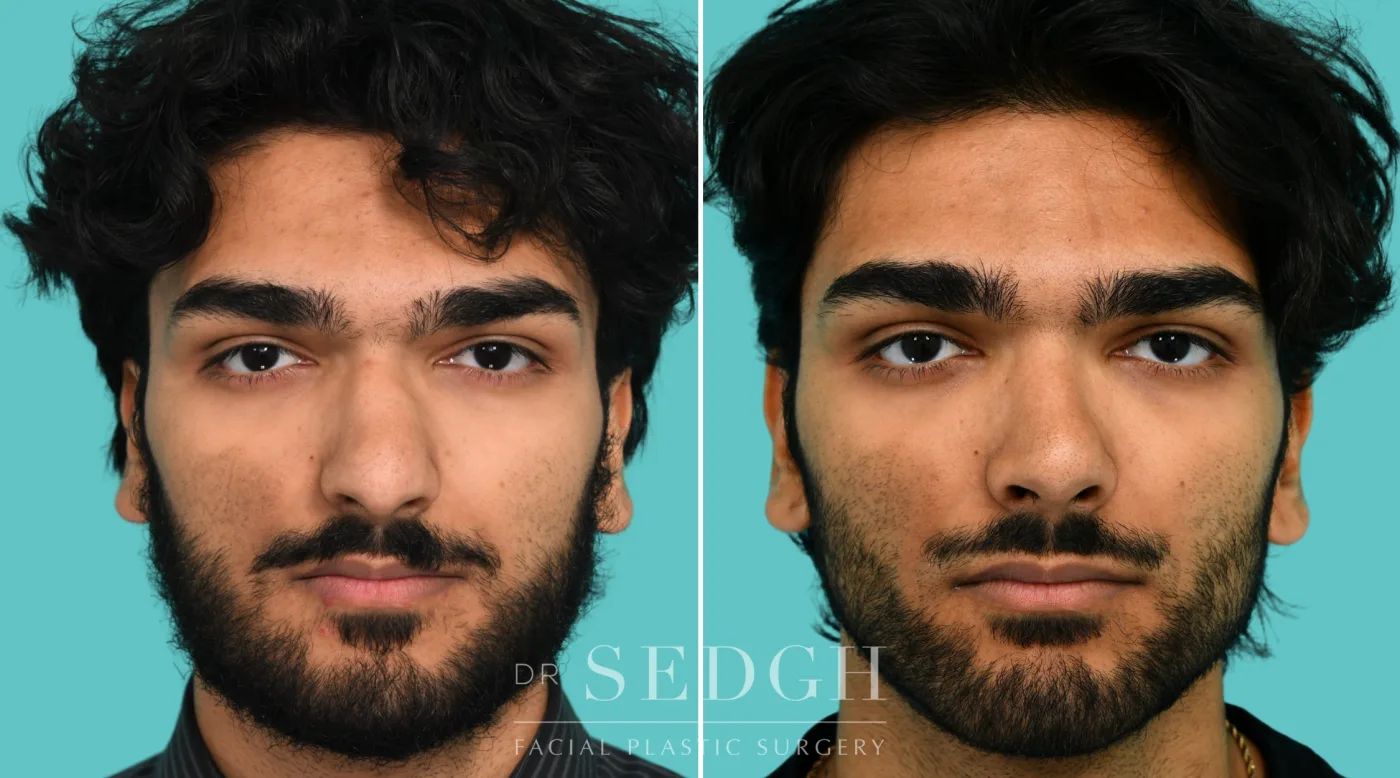 Patient 364 after Male Rhinoplasty, view 1