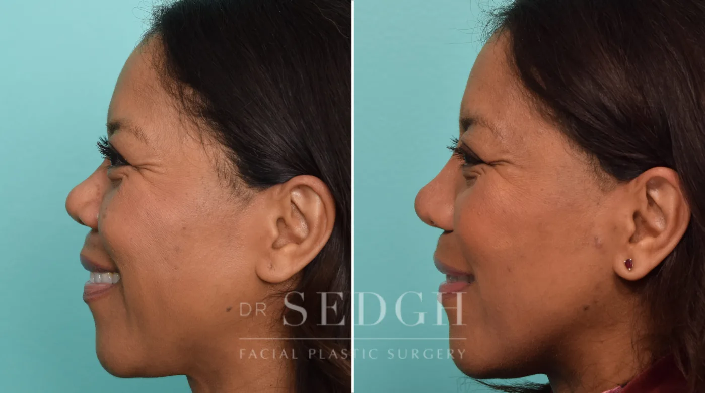 Patient 288 after Asian Rhinoplasty, view 1