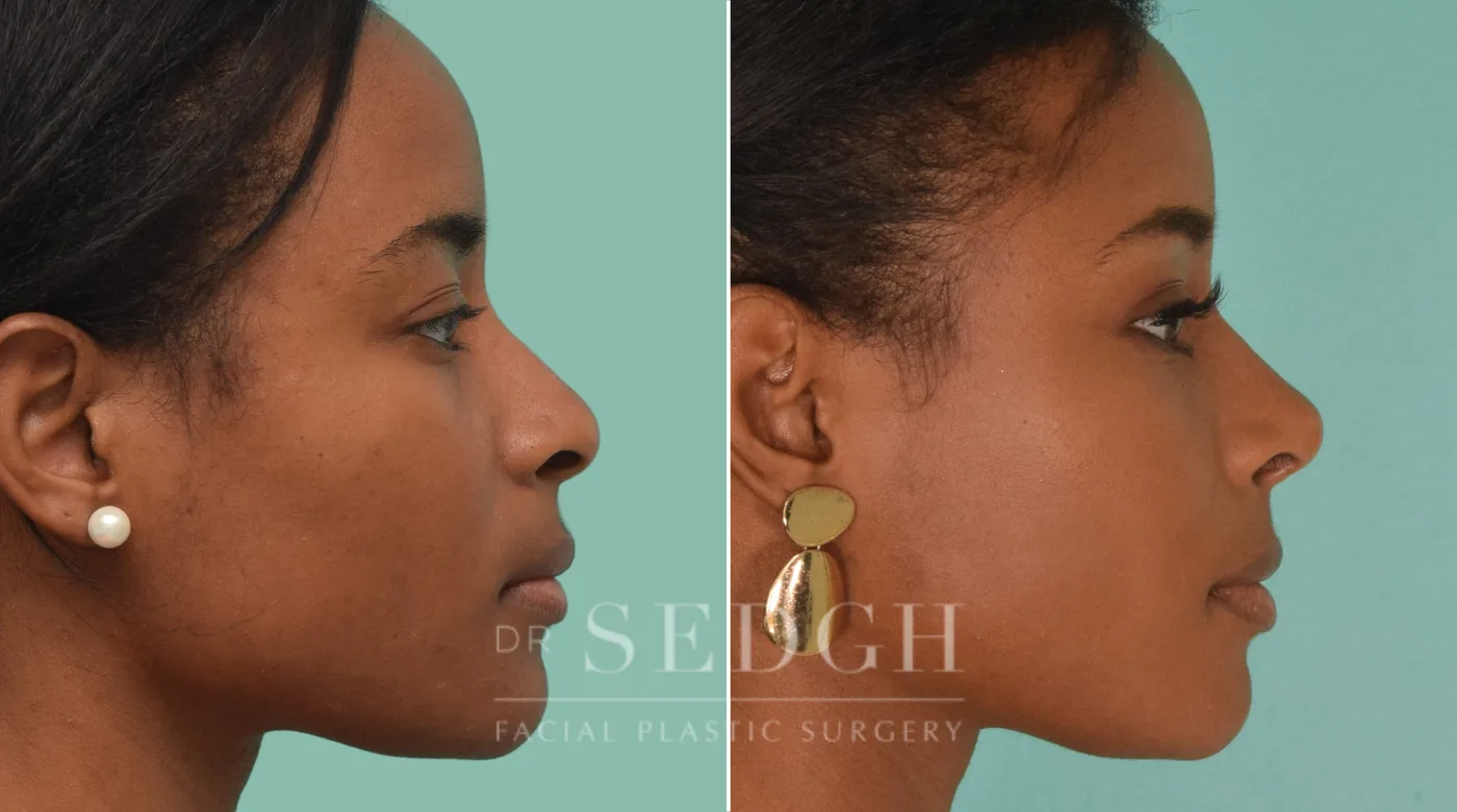 Patient 190 after Female Rhinoplasty, view 1