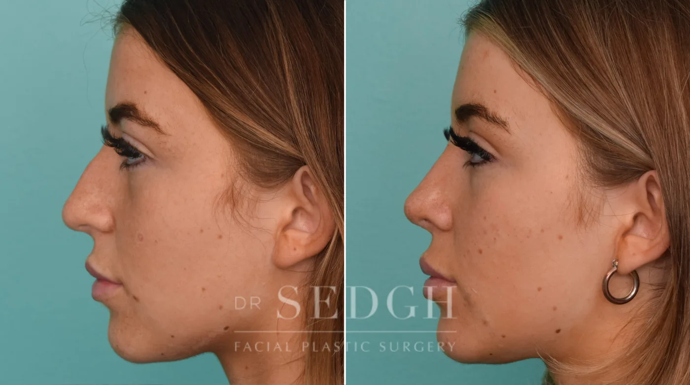 Patient 242 after Rhinoplasty, view 2