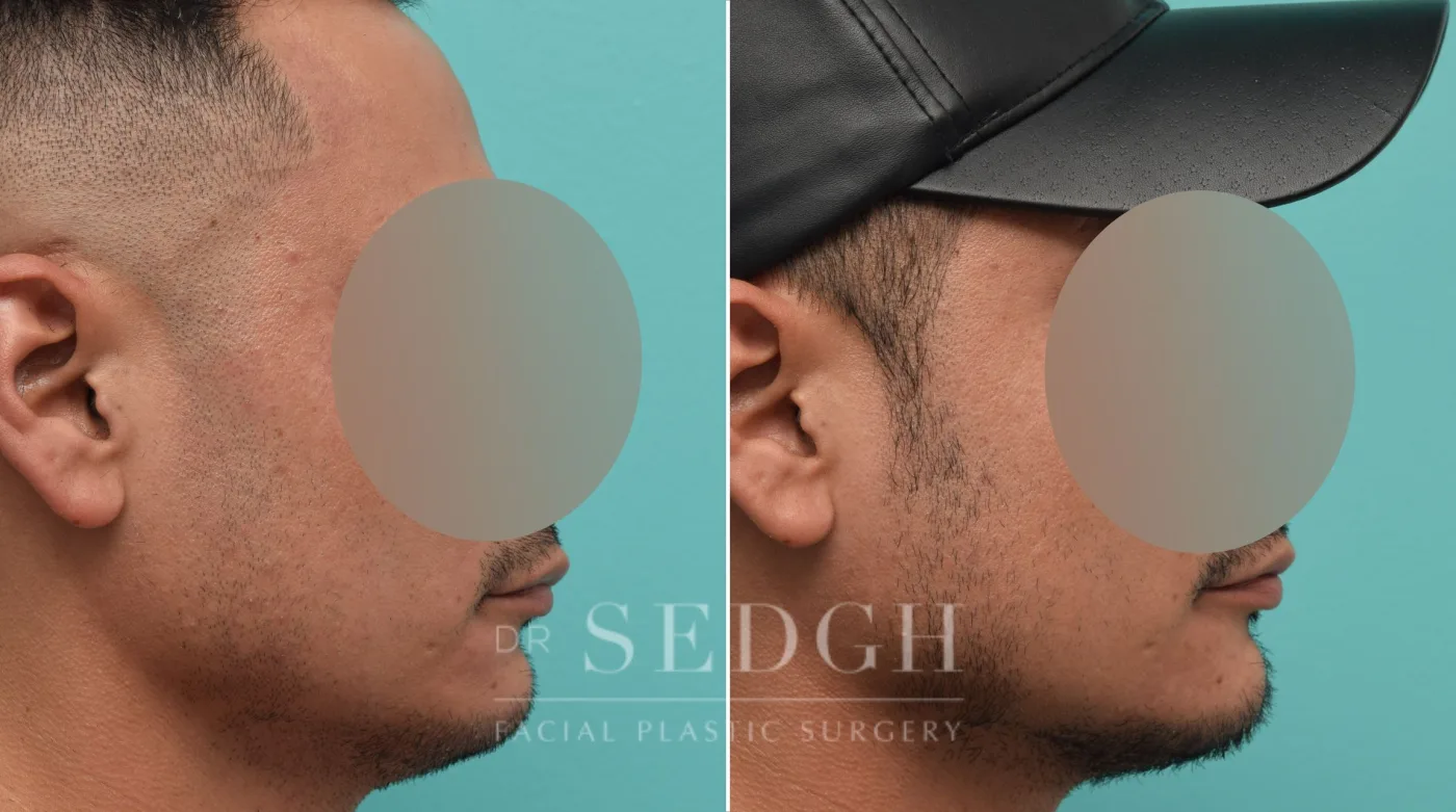 Patient 147 after Chin Augmentation, view 1