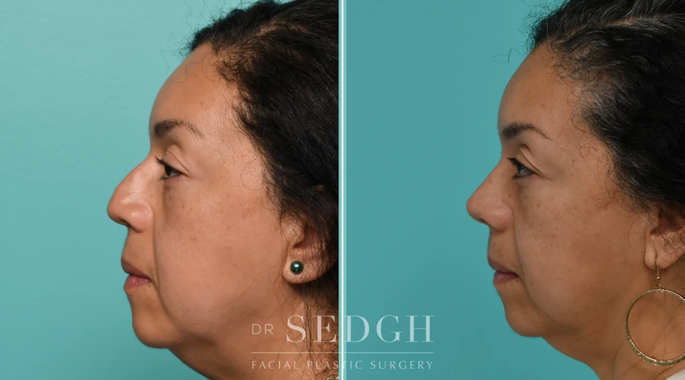 Patient 341 after Hispanic Rhinoplasty, view 2