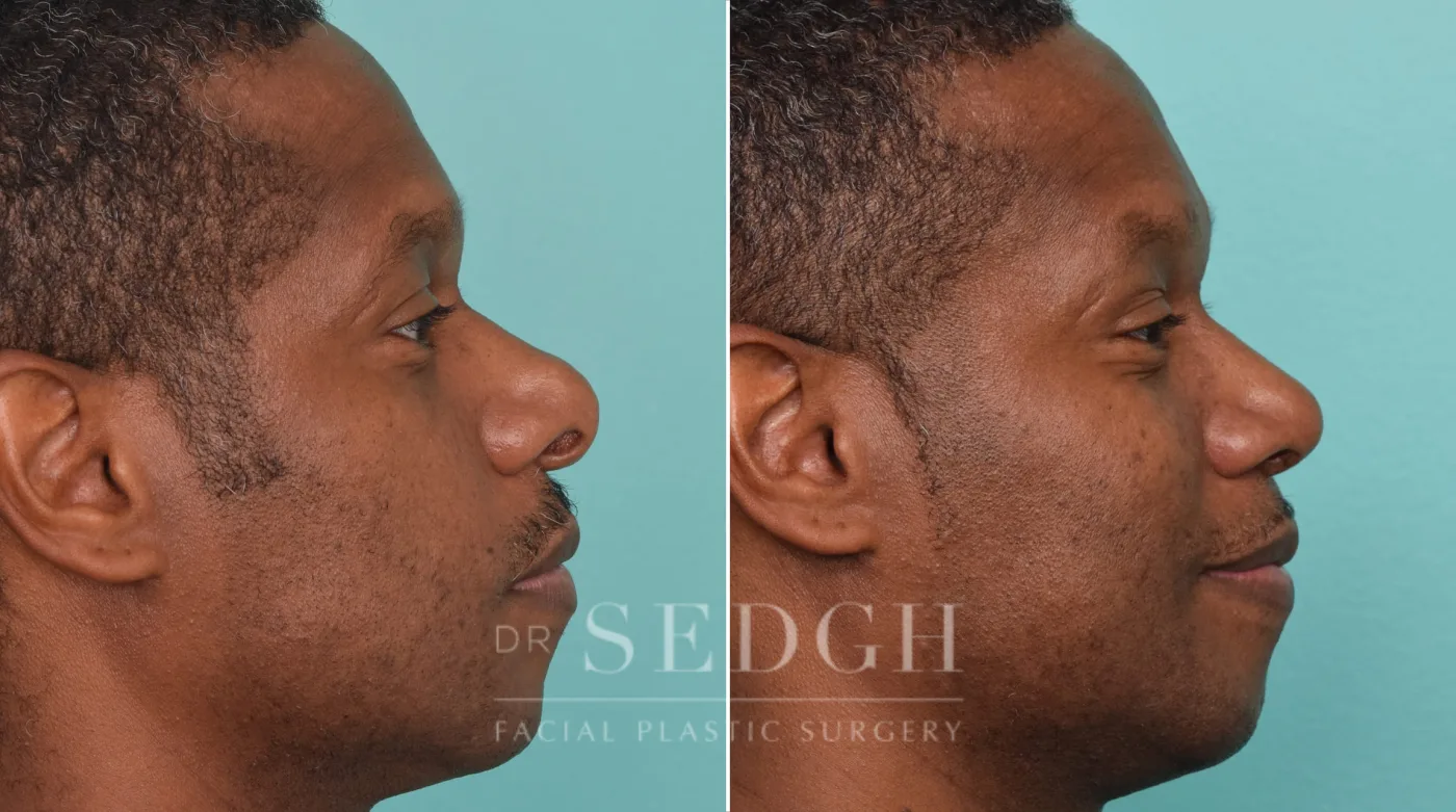 Patient 272 after African American Rhinoplasty, view 2