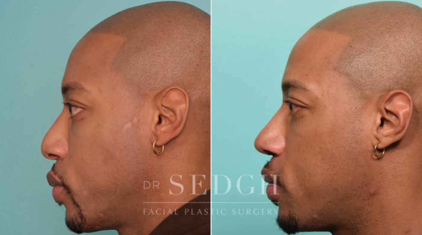 Patient 266 after African American Rhinoplasty, view 1