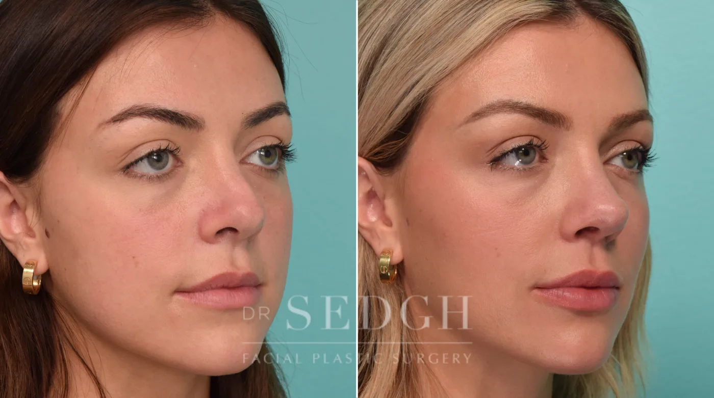 Patient 279 before Revision Rhinoplasty, view 1