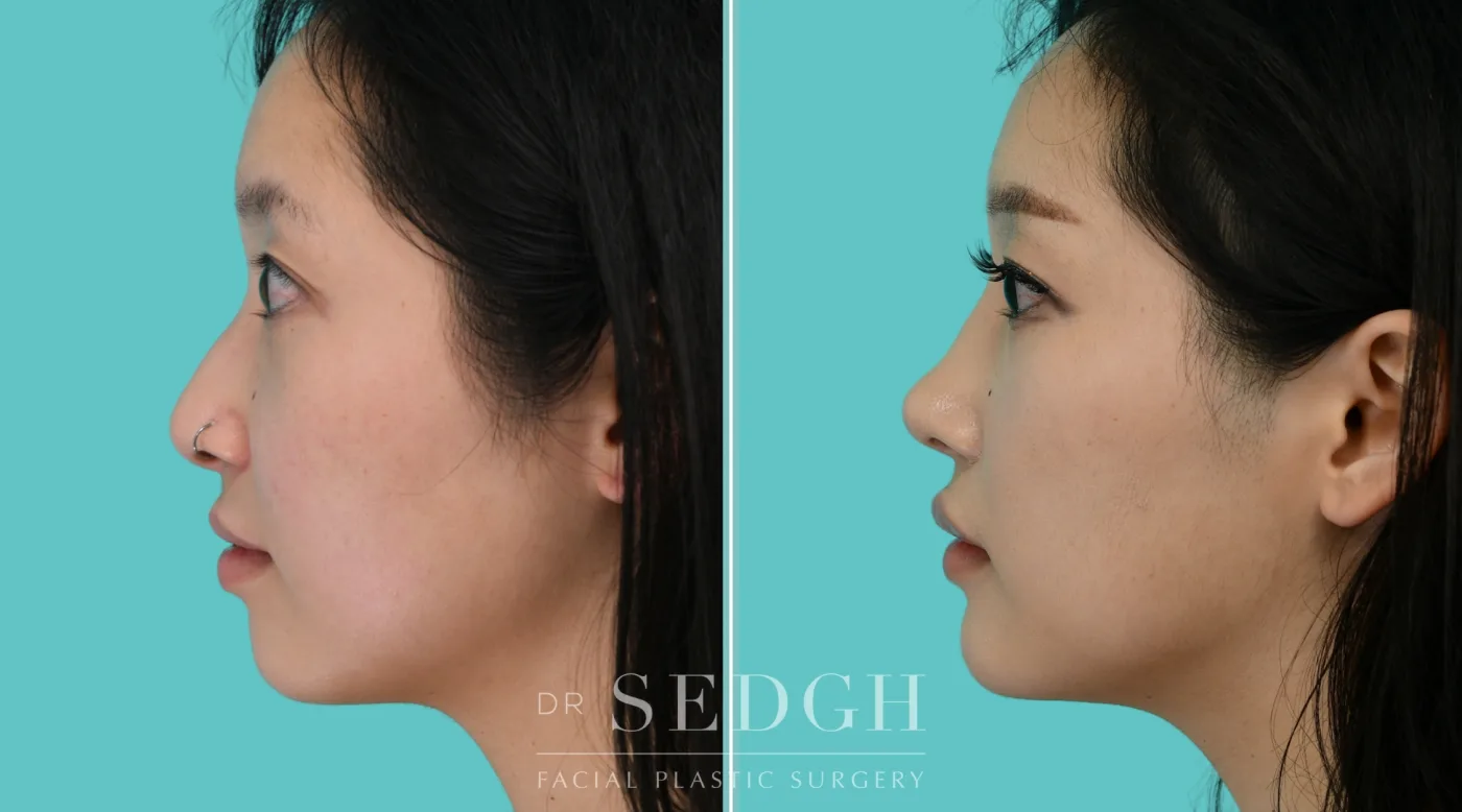 Patient 353 before Asian Rhinoplasty, view 4