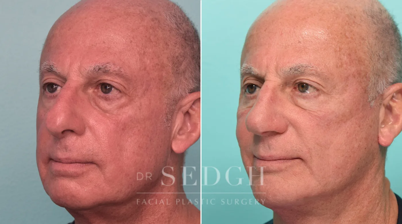 Patient 292 before Face Lift, view 2