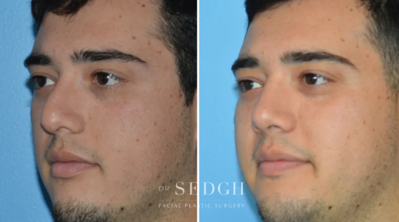 Patient 7 before Crooked Nose Surgery, view 1