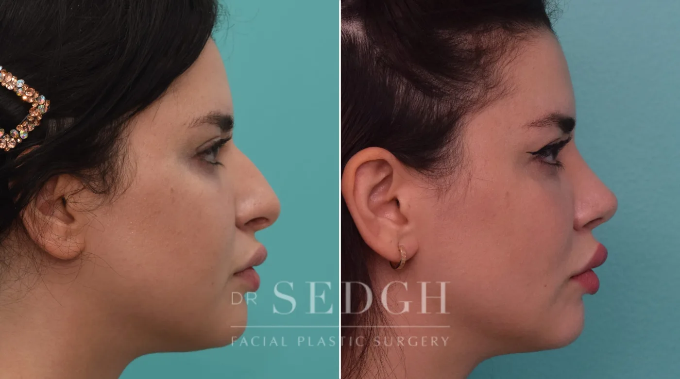 Patient 195 after Rhinoplasty, view 2