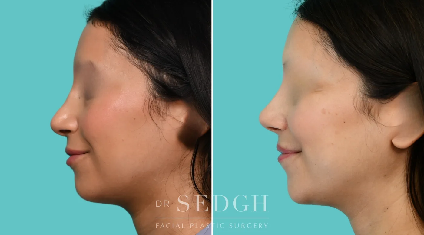 Patient 354 after Revision Rhinoplasty, view 3