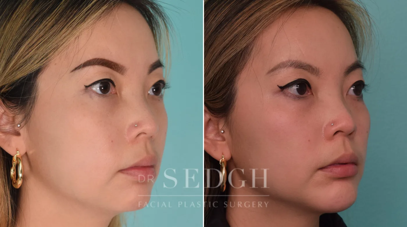 Patient 209 before Chin Augmentation, view 1