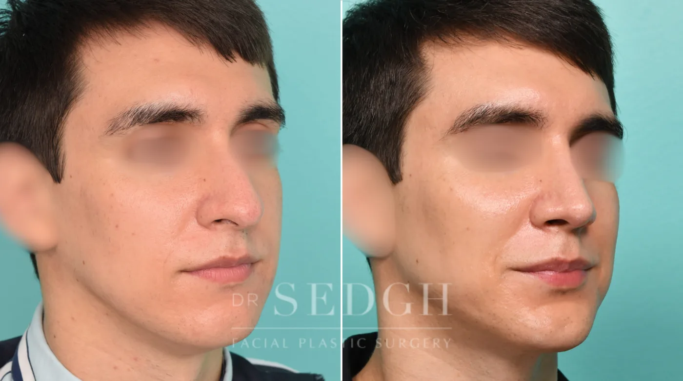 Patient 317 before Neck Liposuction, view 1