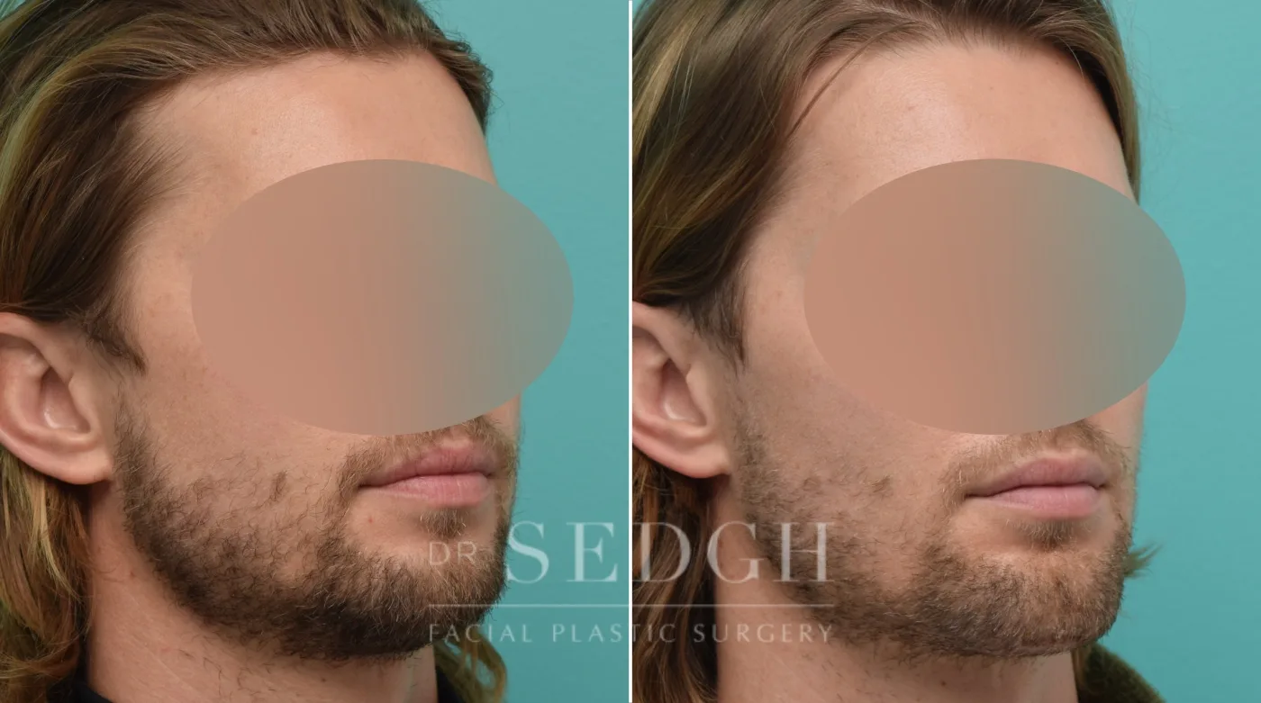 Patient 146 before Chin Augmentation, view 1