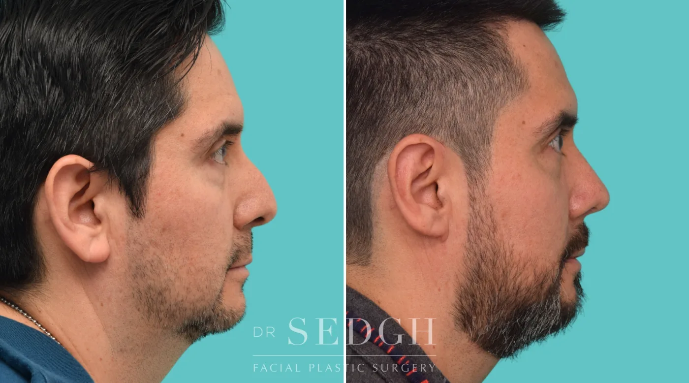 Patient 355 before Hispanic Rhinoplasty, view 1