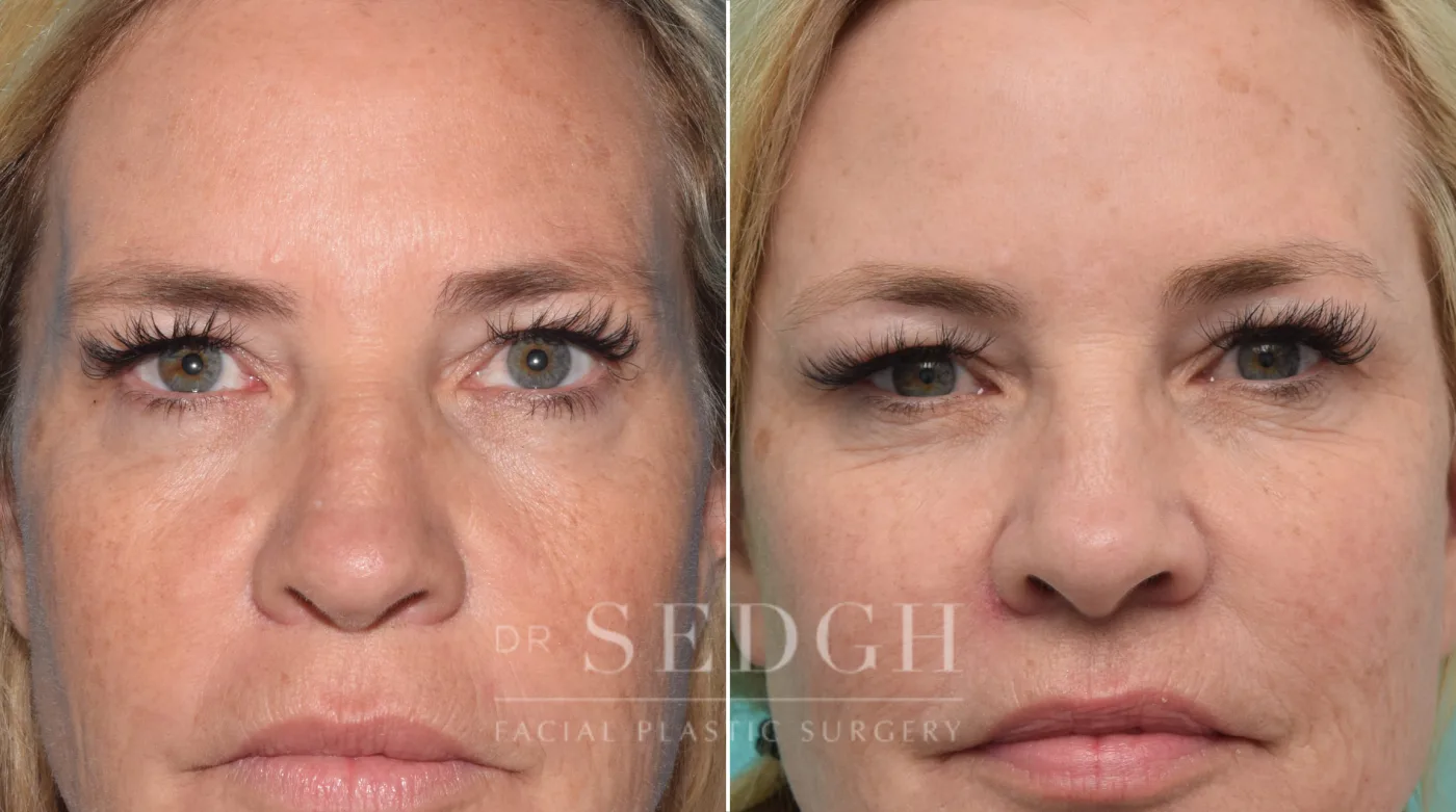 Patient 183 before Facial Fillers, view 1