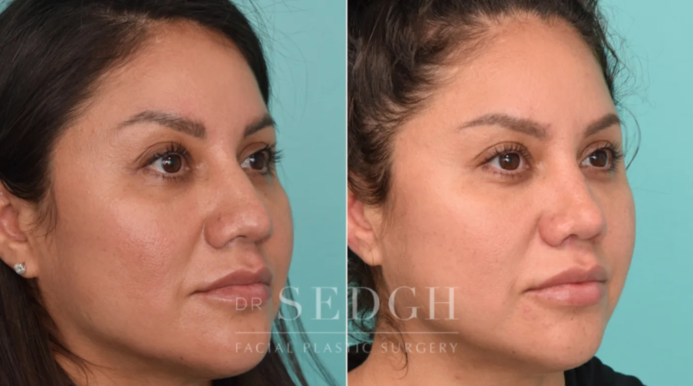 Patient 282 before Hispanic Rhinoplasty, view 2