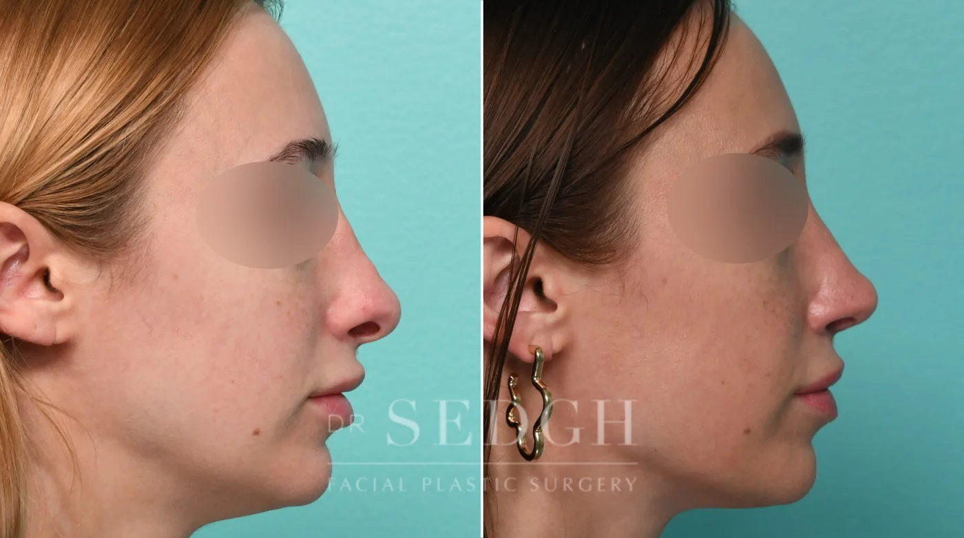 Patient 329 after Revision Rhinoplasty, view 1