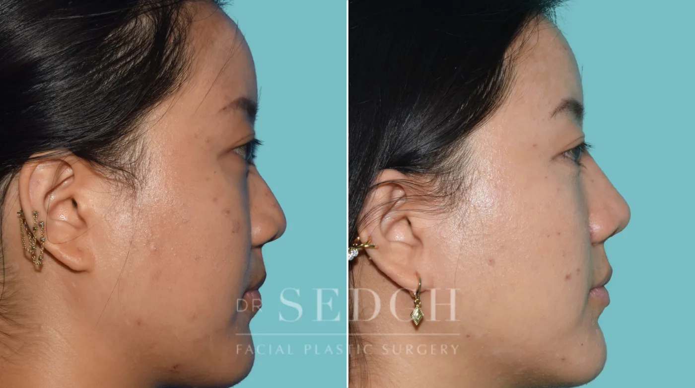 Patient 36 after Middle Eastern Rhinoplasty, view 1