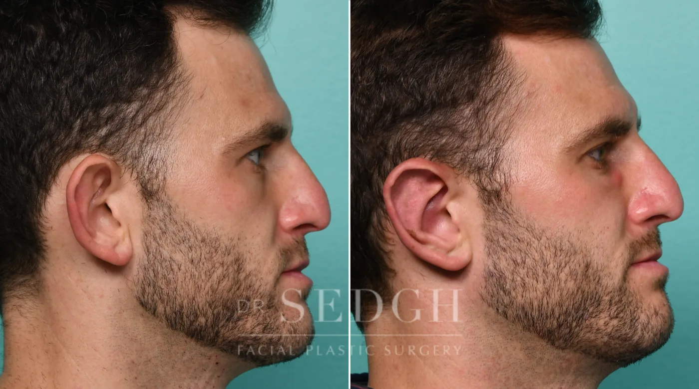 Patient 320 after Ear Pinning Surgery, view 1
