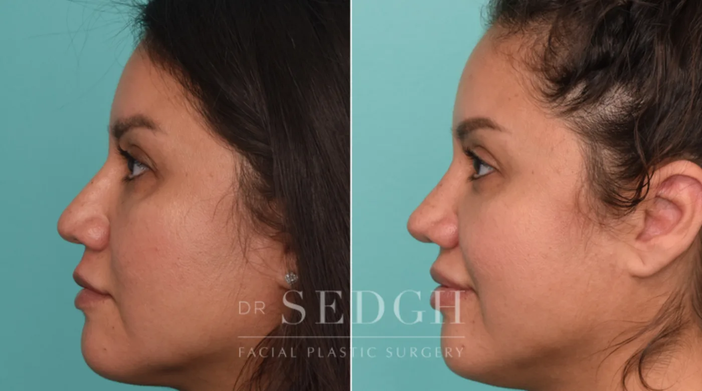Patient 282 after Hispanic Rhinoplasty, view 1