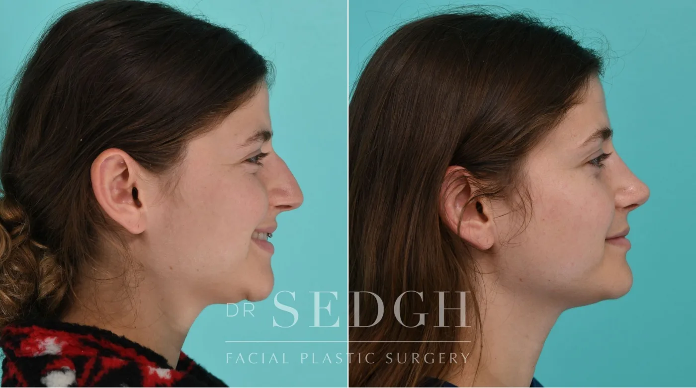 Patient 338 after Female Rhinoplasty, view 1