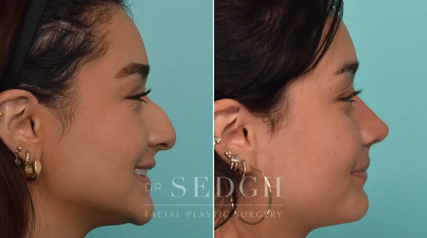 Patient 287 after Female Rhinoplasty, view 2