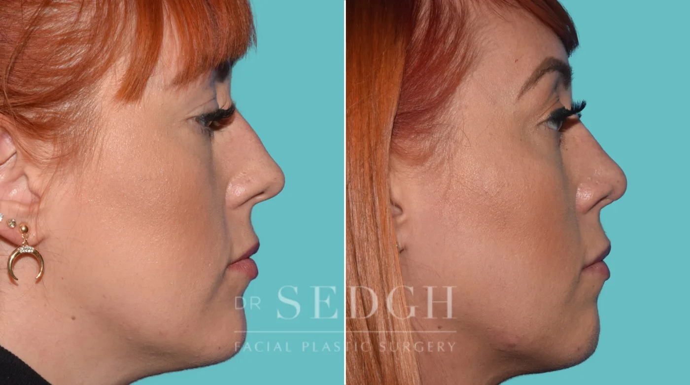 Patient 38 after Facial Fillers, view 1