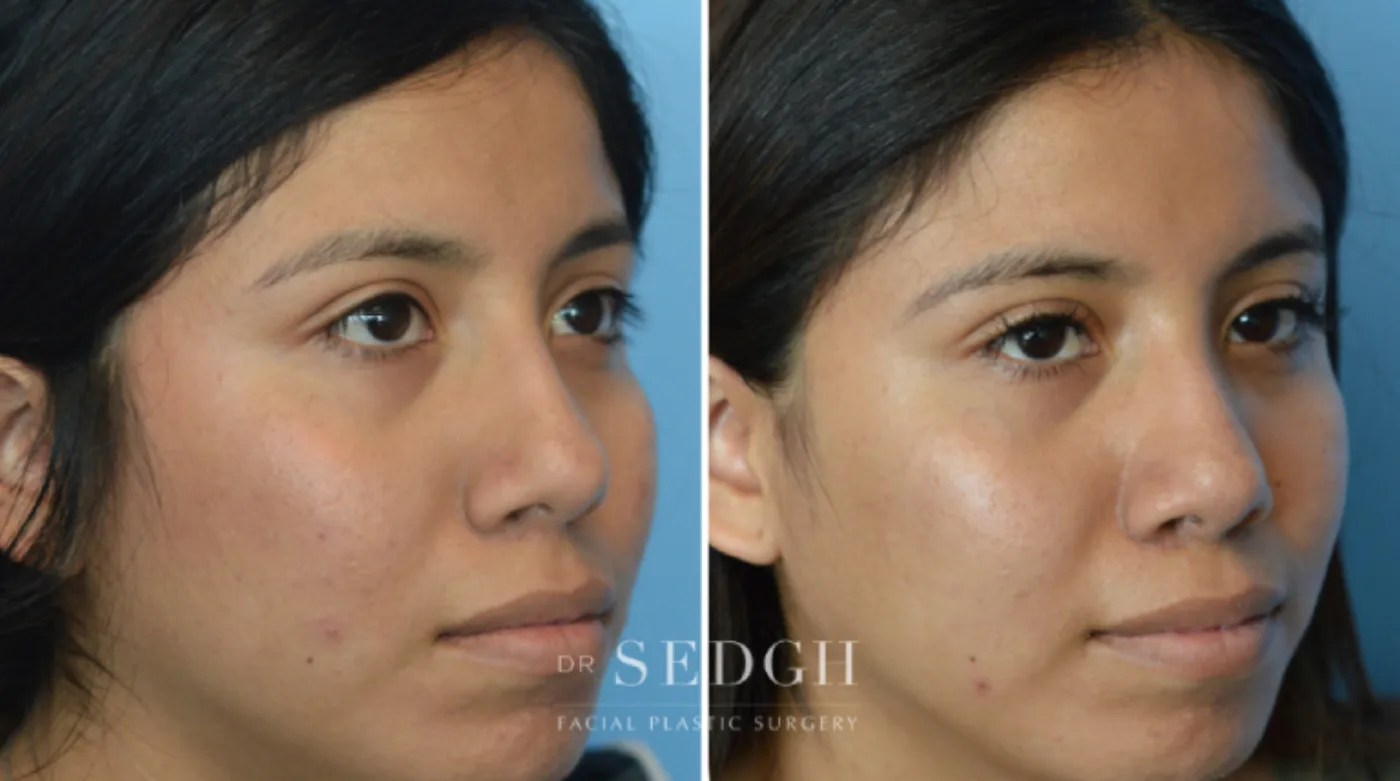 Patient 13 before Crooked Nose Surgery, view 2