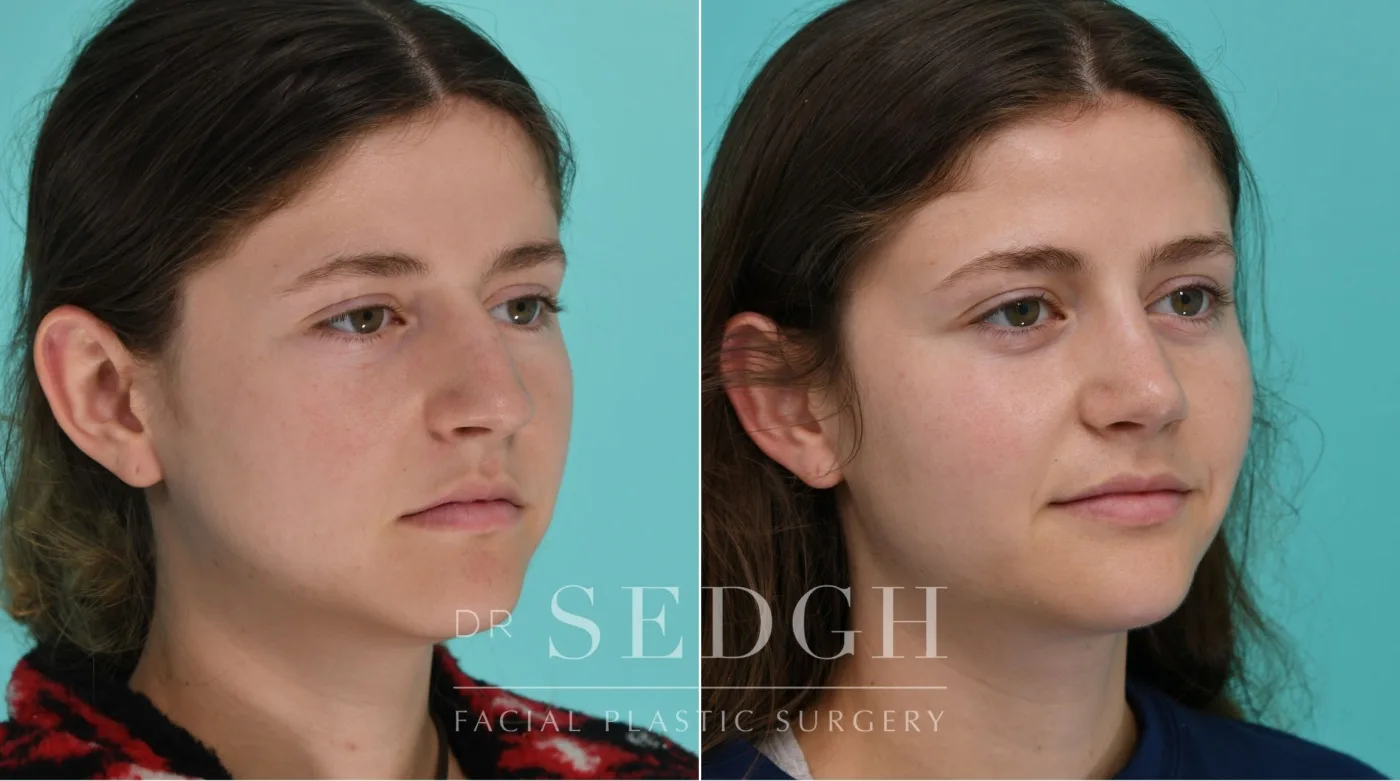 Patient 338 before Female Rhinoplasty, view 2