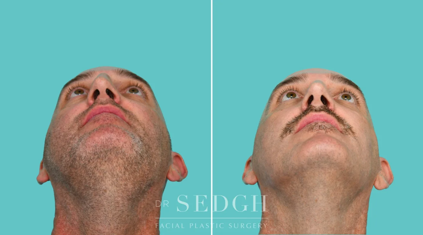 Patient 335 after Male Rhinoplasty, view 4