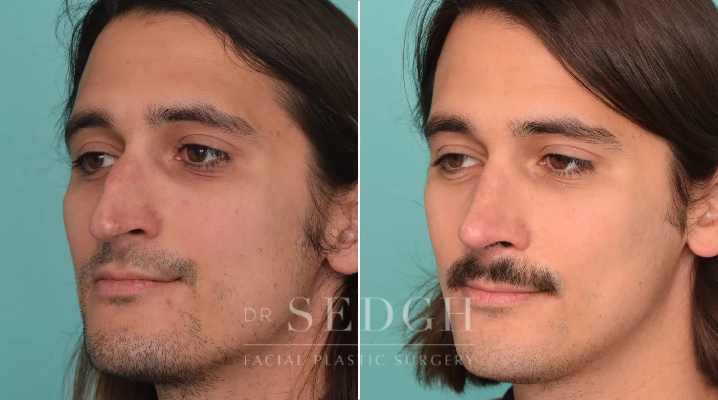 Patient 224 before Rhinoplasty, view 1