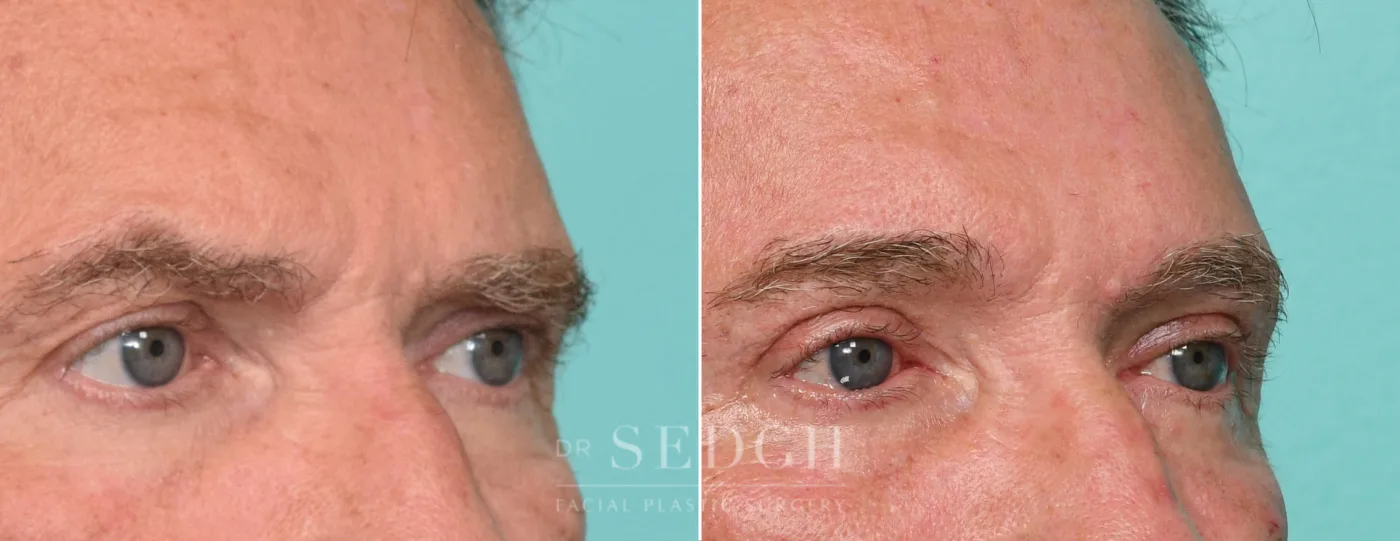 Patient 315 before Upper Blepharoplasty, view 2