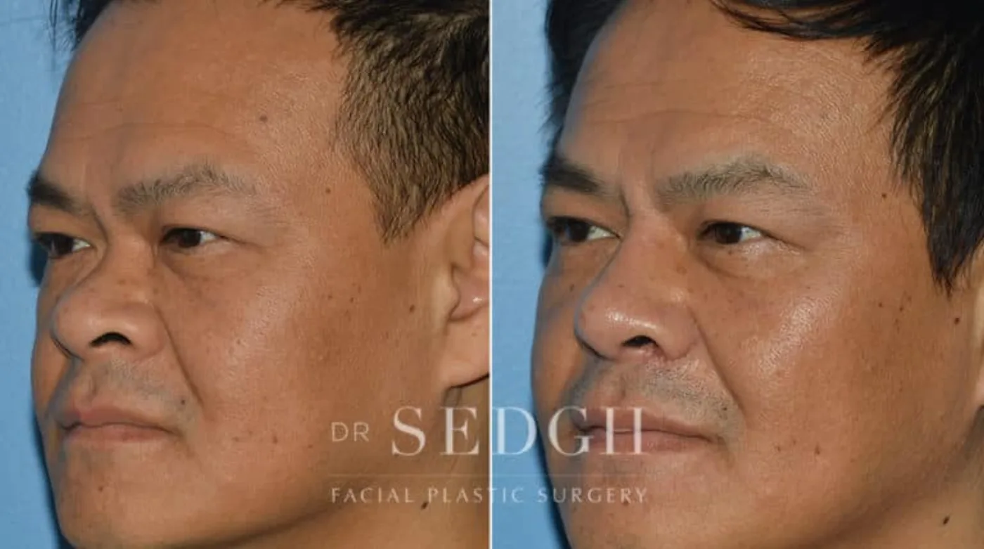 Patient 5 before Middle Eastern Rhinoplasty, view 1