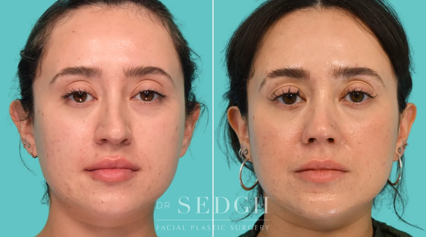 Patient 340 after Revision Rhinoplasty, view 3