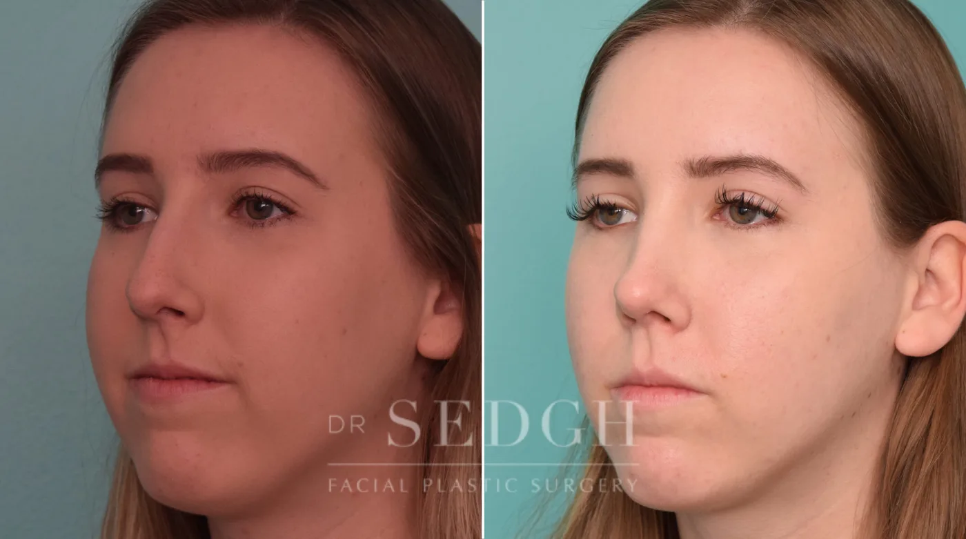 Patient 226 before Facial Fillers, view 1