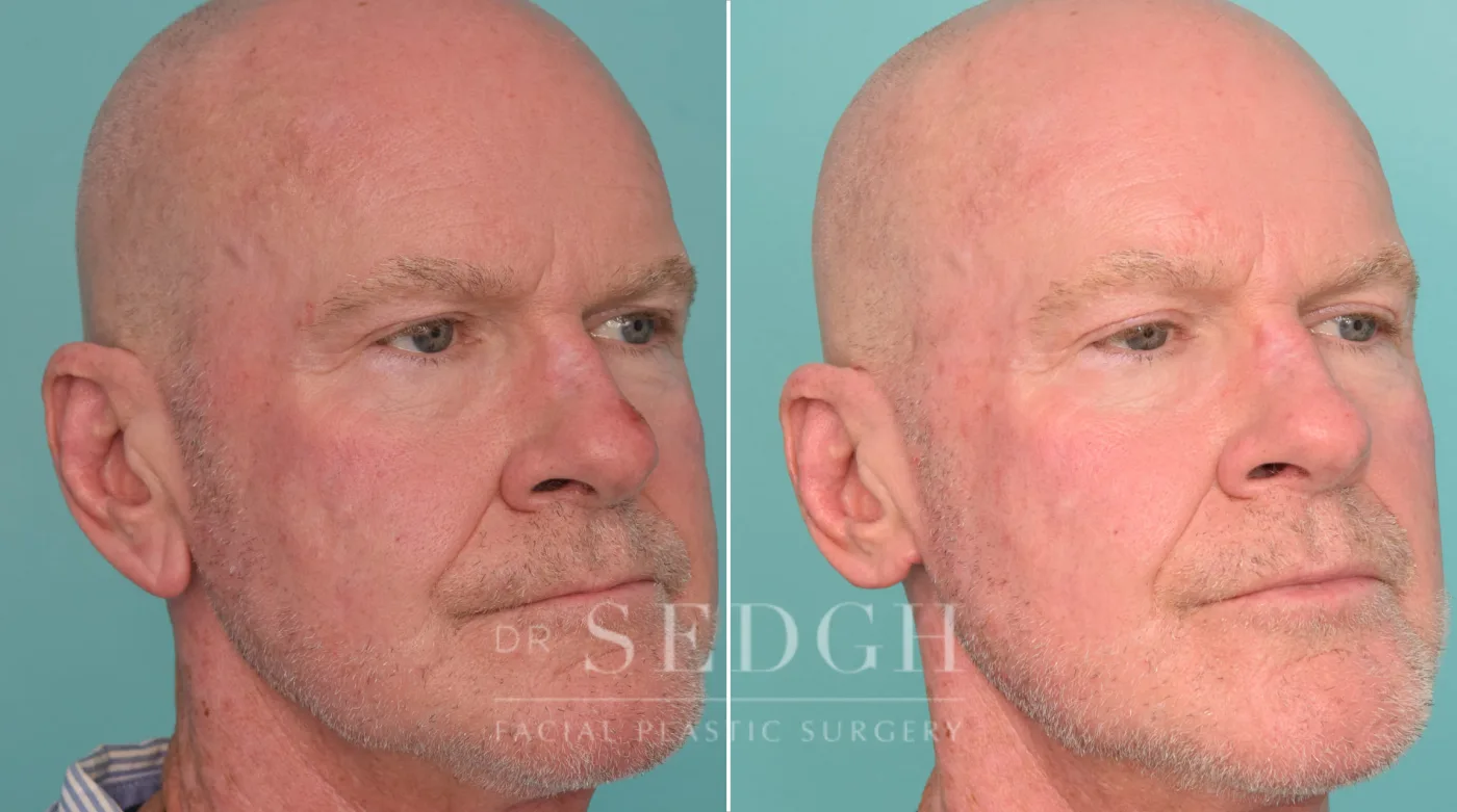 Patient 2 before Ear Lobe Reduction, view 1